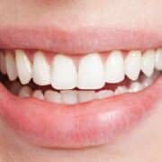 Invisaglin hammasmuotit ratkaisu